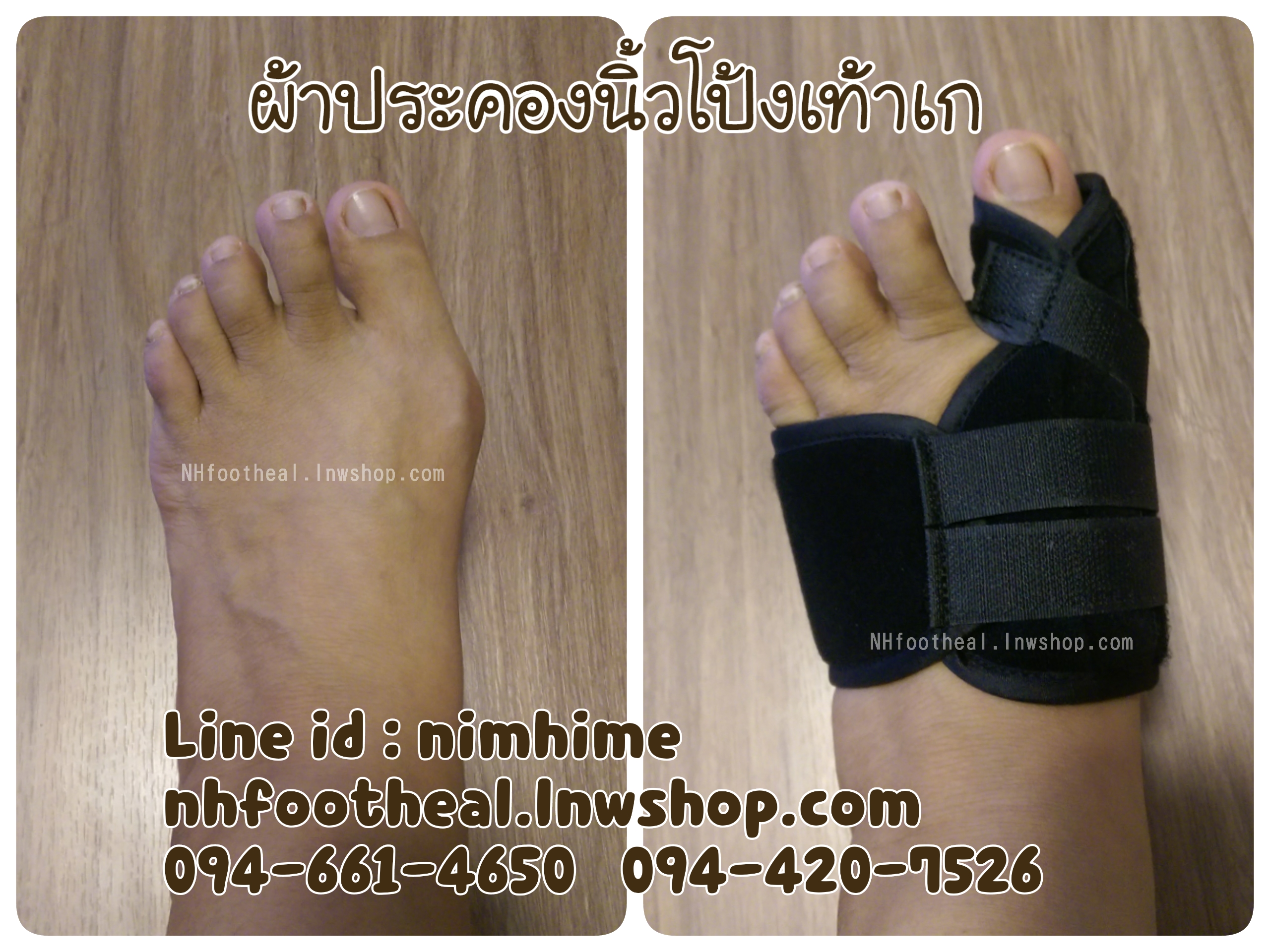 แบบที่4 ไซส์ M อุปกรณ์ดูแลนิ้วโป้งเท้าเก ภาวะนิ้วโป้งเท้าเก (Hallux Valgus)