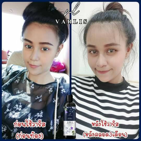 แชมพู Varlis ขจัดทุกปัญหาเส้นผม ลดผมร่วง เร่งผมยาว สำหรับทุกสภาพผม