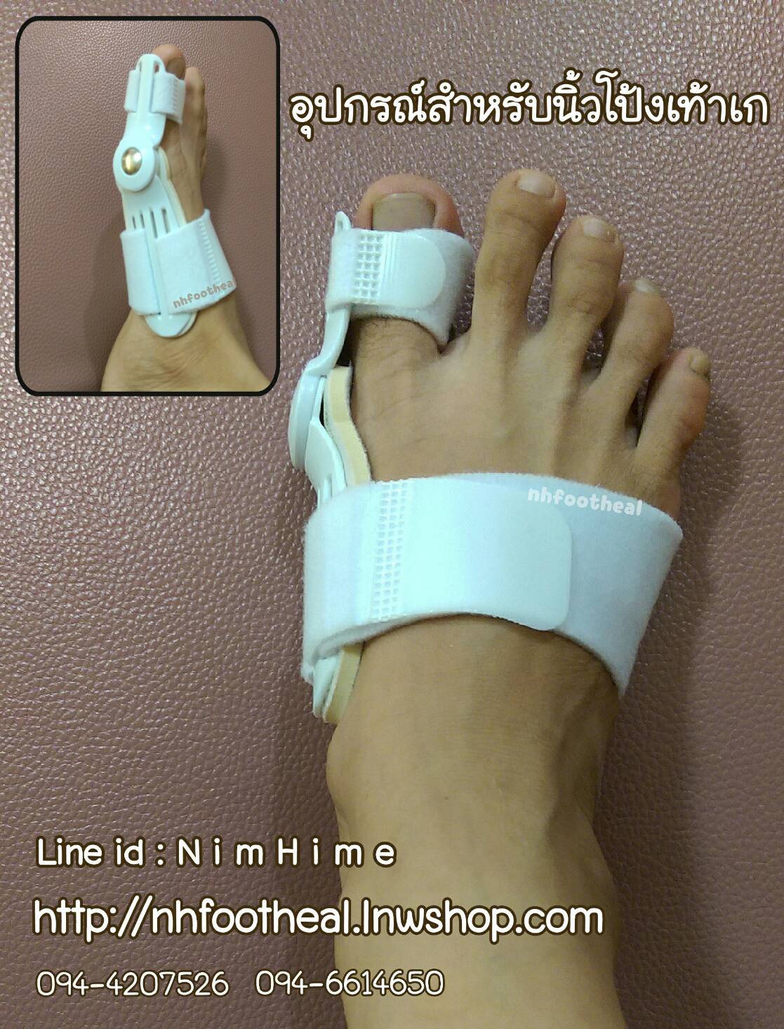 แถบผ้ารัดนิ้วโป้งเท้าเก ภาวะนิ้วโป้งเท้าเก (Hallux Valgus)