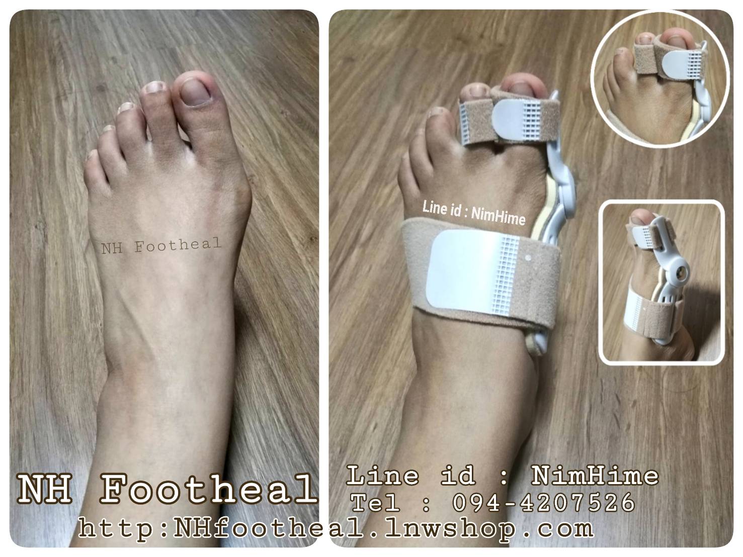 แถบผ้ารัดนิ้วโป้งเท้าเก ภาวะนิ้วโป้ง นิ้วชี้เท้าเก (Hallux Valgus)