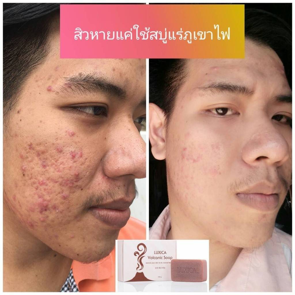 สบู่ลูซิก้า โวลคานิค สบู่ลดสิวที่สกัดจากแร่ภูเขาไฟ