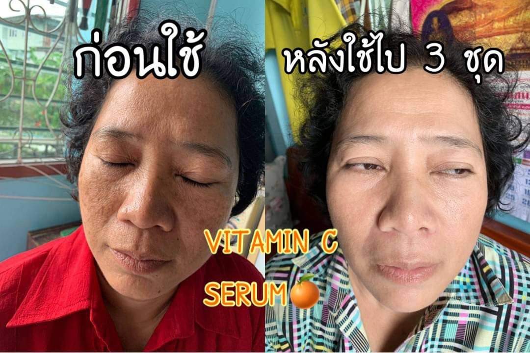 วิตซีเซรั่ม (VIT C Serum) เผยผิวสวยกระจ่างใส ใช้ได้กับทุกสภาพผิวบำรุงผิวสวยได้ทุกวัน