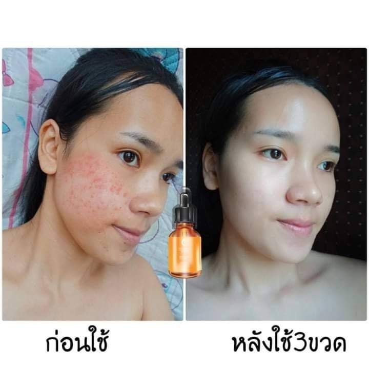 วิตซีเซรั่ม (VIT C Serum) เผยผิวสวยกระจ่างใส ใช้ได้กับทุกสภาพผิวบำรุงผิวสวยได้ทุกวัน